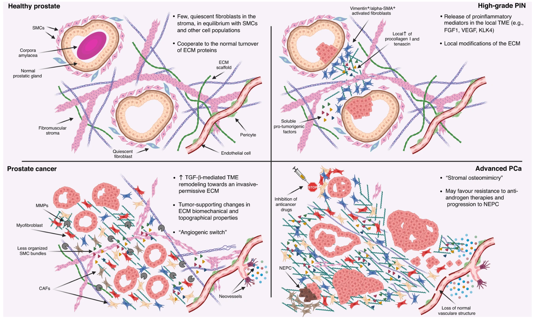 Prostate Cancer